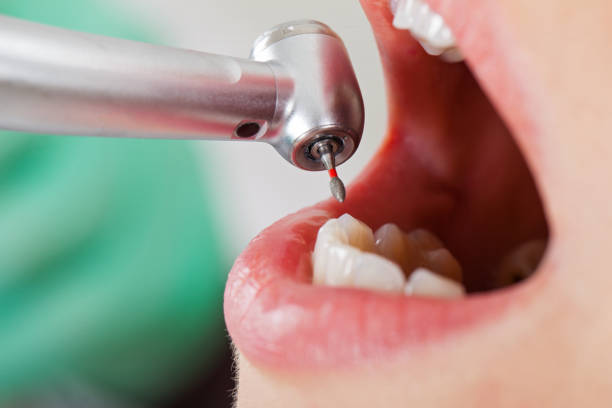 Best Emergency Dental Care for Broken or Chipped Teeth in Sayre, OK